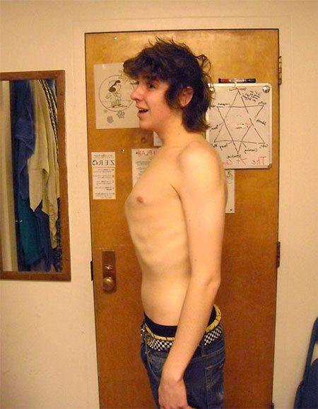 teenager with a pigeon chest